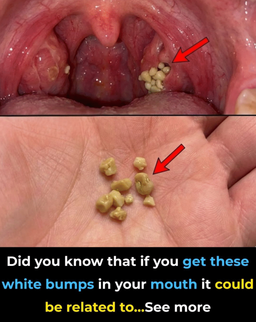 Here’s What You Need to Know About Tonsil Stones
