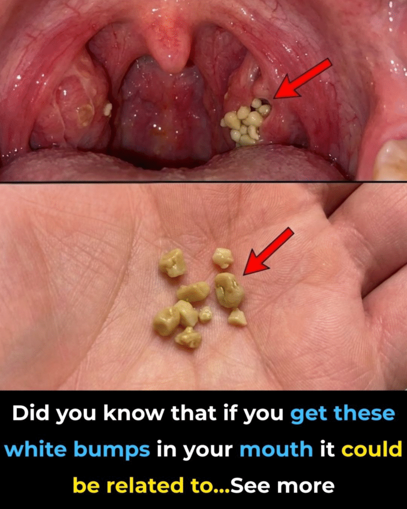 Tonsil Stones: Understanding the Small Lumps That Cause Big Annoyance